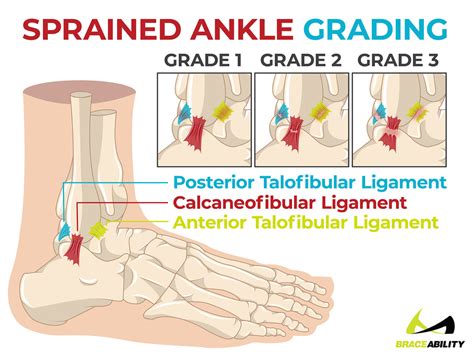 calcaneofibular ligament tear recovery time